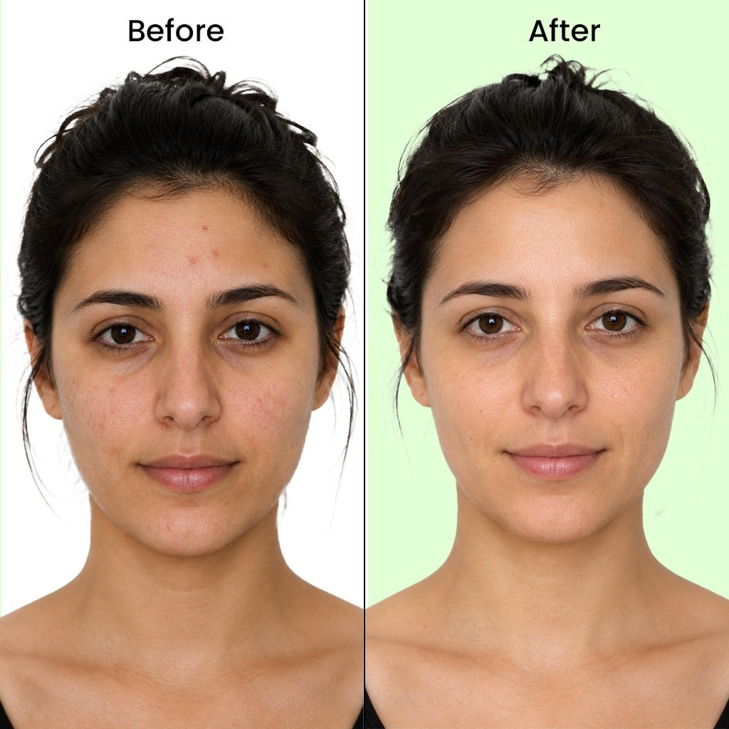 ANTI ACNE FACE SERUM