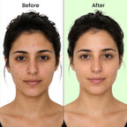 ANTI ACNE FACE SERUM