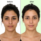 ANTI ACNE KIT