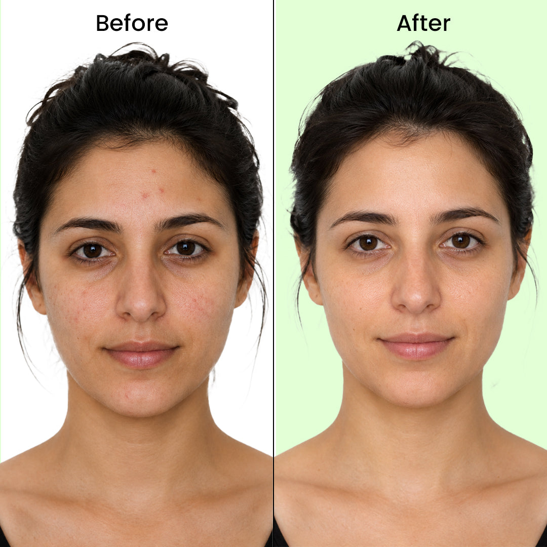 ANTI ACNE KIT